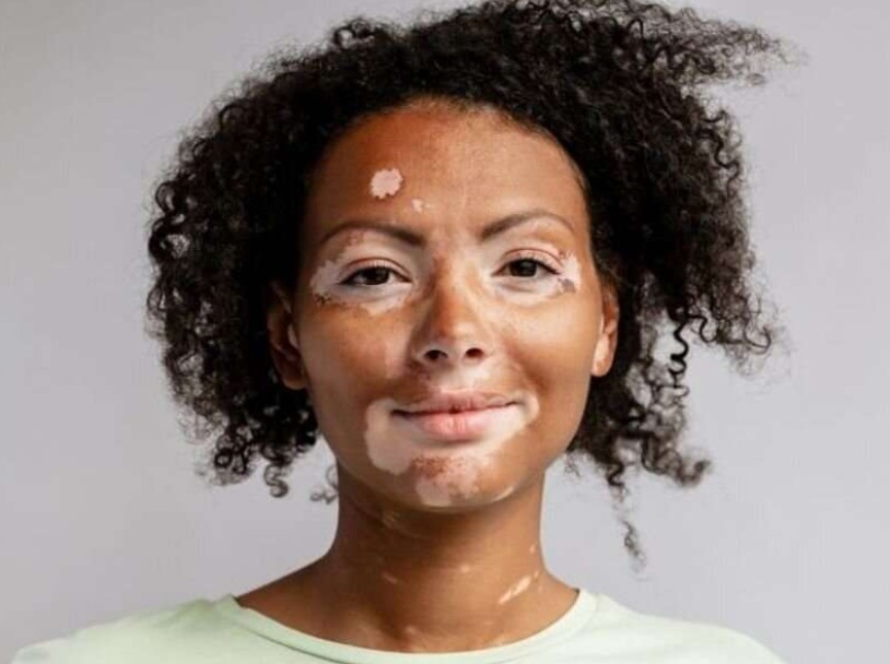 Cali se ilumina de morado en la celebración del día mundial del vitiligo